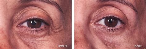 ThermiSmooth® Skin Tightening Treatment in Atlanta, GA.